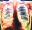 Клинический метод диагностики хронического бронхита у больных туберкулезом легких