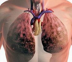 Диагностика ранней стадии хронического бронхита у больных туберкулезом легких