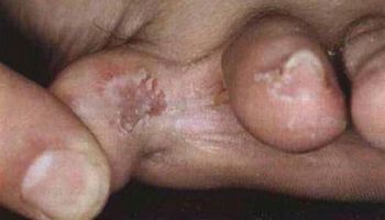 Грибковые поражения кожи и ногтей стоп