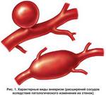 классификация заболеваний аорты артерий